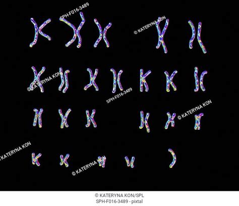Turner Syndrome Karyotype Stock Photos And Images Agefotostock