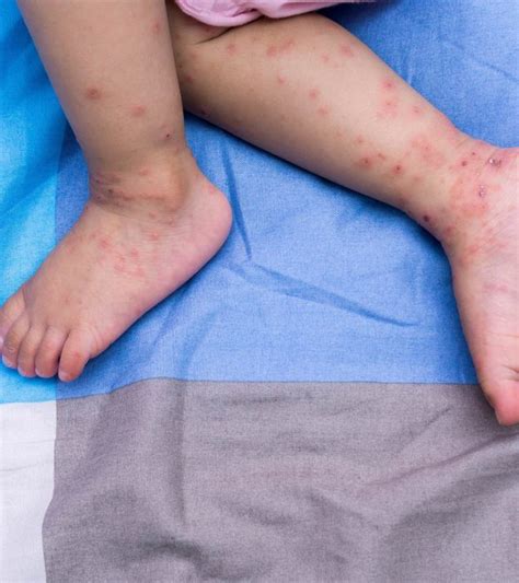 6 Symptoms And Causes Of Hand Foot And Mouth Disease In Babies