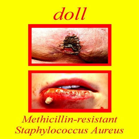 Mrsa Methicillin Resistant Staphylococcus Aureus Doll Hgm