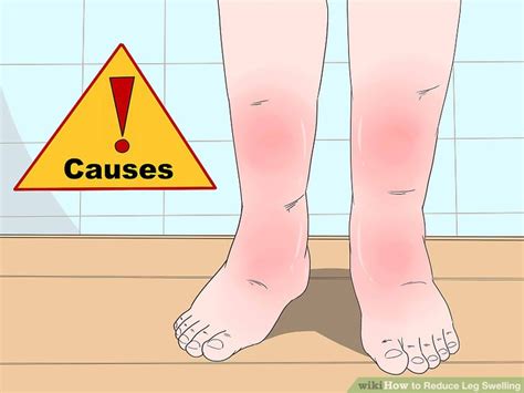 Pictures Of Swollen Ankles Due To Kidney Problems Gertywine