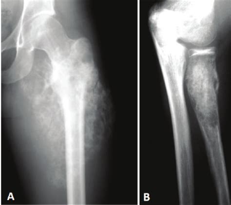 Radiographies Of Osteosarcoma A And Ewings Sarcoma B Ill Defined