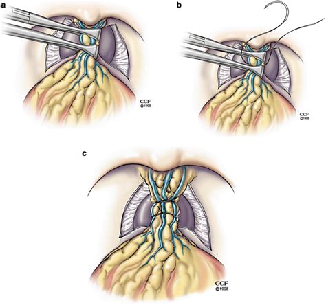 Open Radical Retropubic Prostatectomy And Pelvic Lymph Node Dissection