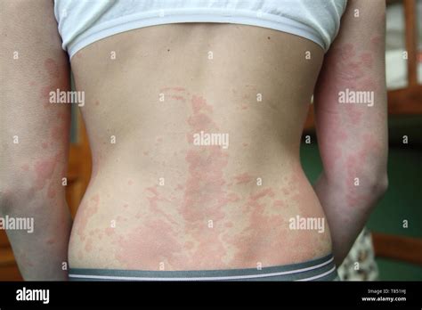 La Dermatite Allergique La Peau De La Petite Fille Est De Retour Est