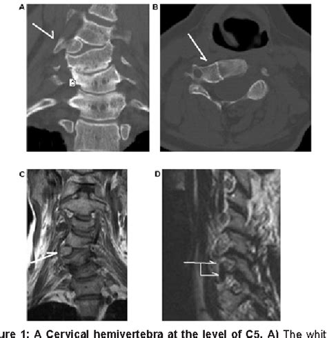 Figure 1 From Clinical Implications Of The Rare Anomaly Of A Cervical
