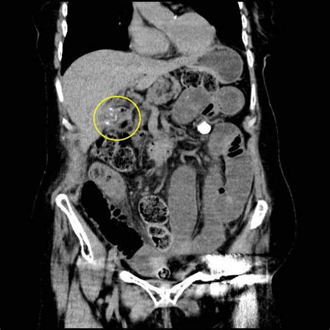 An Uncommon Case Of Gallstone Ileus In A Patient With Ileostomy Eurorad