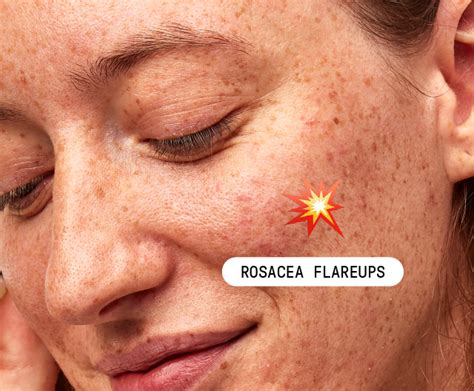 Rosacea Triggers What Causes Your Flare Ups Apostrophe