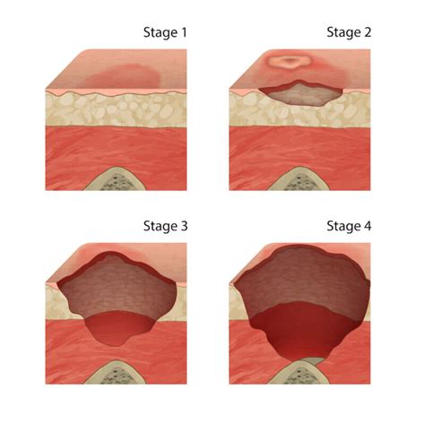 Stage Pressure Ulcers Explained Nyc Bedsore Lawyer