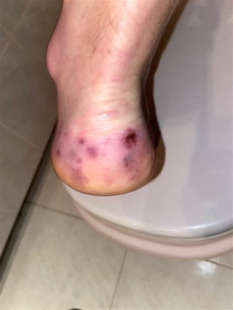 Coronavirus Patient 24 Shows His Swollen And Purple Covid Toes