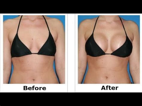 Don't wait, get the best treatment options today! How to Get Bigger Breasts | How to Get bigger breasts ...