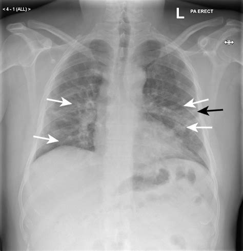 The Role Of Chest Radiography In Confirming Covid 19 Pneumonia The Bmj