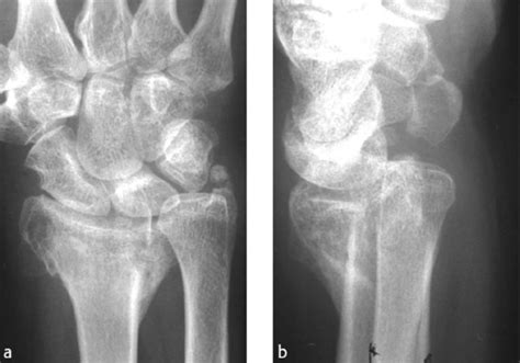53 Distal Radius Osteotomy For Malunion Dorsal Approach Plastic
