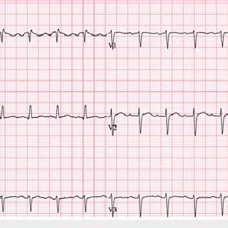 EKG Of The Patient While On Modafinil Showing Sinus Tachycardia With A