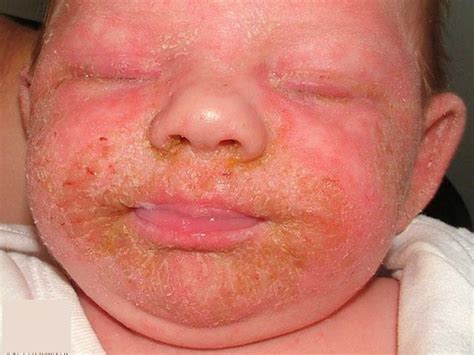 Infantile Seborrheic Dermatitis Causes Symptoms Diagnosis Treatment