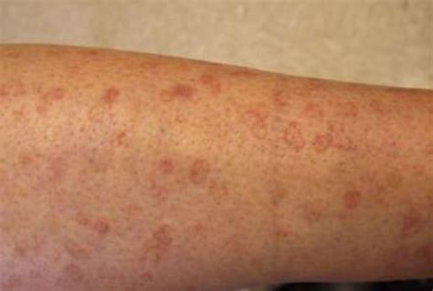 Brown Spots On Legs Pictures Photos