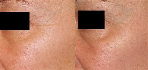 Laser Skin Rejuvenation Canterbury And Kent The Grove Clinic