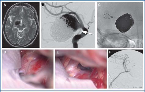 Figure From Surgical Management Of Giant Posterior Communicating Artery Aneurysms Semantic