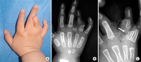 Case 8 Right Hand Of A 2 Year Old Boy Synpolydactyly With A Cross