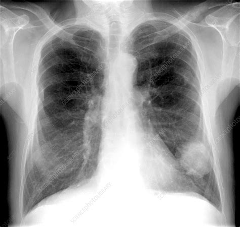 Lung Cancer X Ray Stock Image C0103430 Science Photo Library