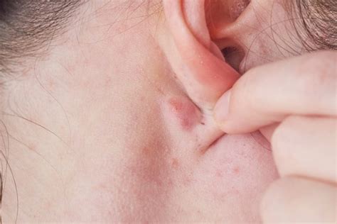 Hard Lump Behind The Ear 6 Causes And What To Do Tua Saúde