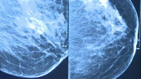 3d Mammograms Helping Save Lives Nbc News