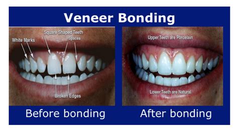 Veneers Dentistry At Vickery Creek