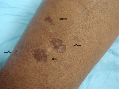 Recognizing Skin Popping Scars And The Benefits Of Early Intervention