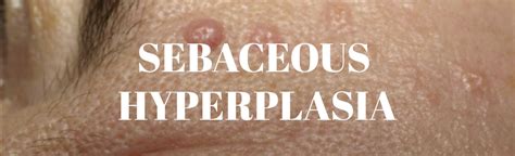 Sebaceous Hyperplasia Beautyologist