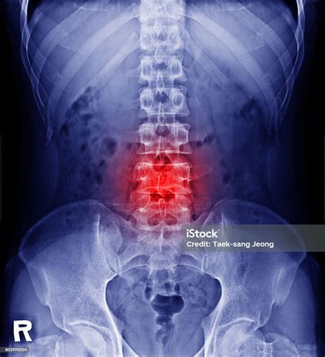 영화 X 선 척추 허리 척추와 골반 허리통증에 대한 스톡 사진 및 기타 이미지 허리통증 등 낮음 iStock
