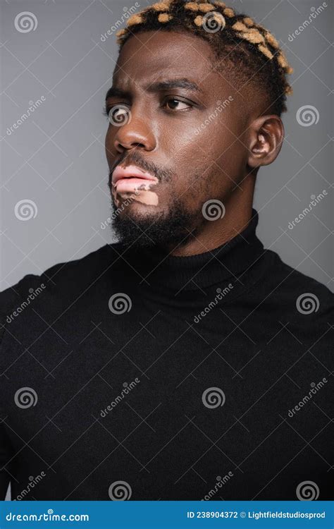 Serious African American Man With Vitiligo Stock Photo Image Of Young