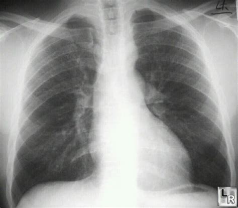 Figure 3 Sign In Coarctation Of The Aorta Radiology Imaging