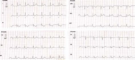 12 Lead Ecg Highlighting St Segment Elevation In Leads I And Avl