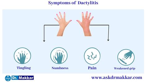 Dactylitis Sausage Fingers Digit Swelling Of Fingers And Toes