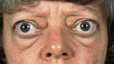 Exophthalmos Bulging Eyes Due To Thyroid Disease Stock