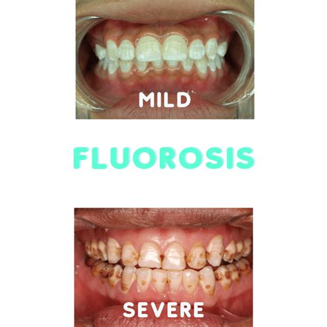 Ways To Prevent Fluorosis Childrens Happy Teeth