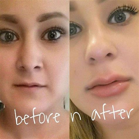 Before And After Picture Of Syringe Of Juvederm To The Lipscall To