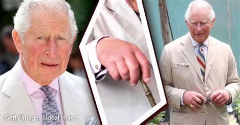 Swollen, red limbs (hands and feet) can result from excess alcohol consumption, salt retention, edema, high blood pressure or poor circulation. Fans Are Worried About Prince Charles' Dreadfully Swollen ...