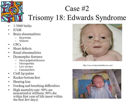 14 Best Trisomy 13 Aka Patau Syndrome Images On Pinterest Website
