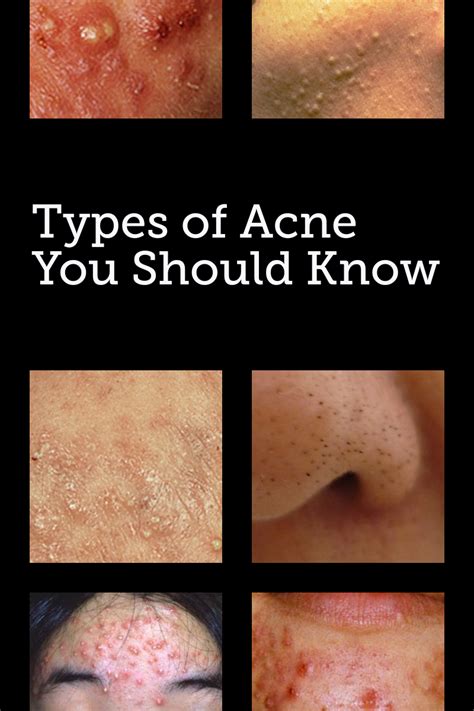What Type Of Acne Do You Have Find Out How The Different Types Are My
