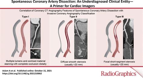Spontaneous Coronary Artery Dissection An Underdiagnosed Clinical