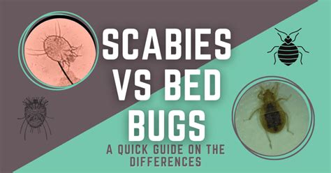 Scabies Vs Bed Bugs Quick Guide To Spot The Differences