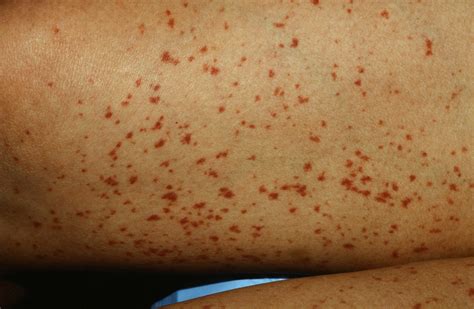 Red Spots On Skin Not Itchy 17 Causes Treatments Home