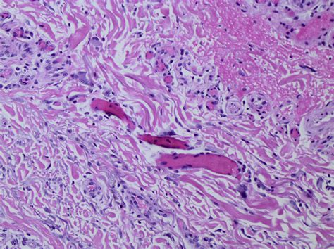 Successful Treatment Of Multinucleate Cell Angiohistiocytoma In An