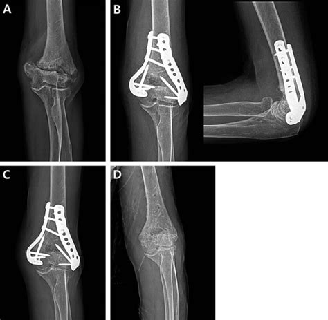 Open Reduction And Internal Fixation For Nonunion Of Extra Articular