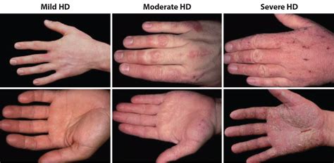 Hand Dermatitis Hand Eczema Dermnet