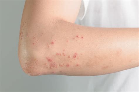 Possible Causes For Those Bumps On Your Skin Facty Health