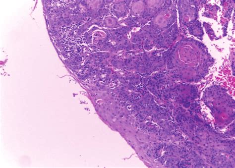 Carcinoma Oral De Células Escamosas Nidos Invasivos De Tumor Rodeados