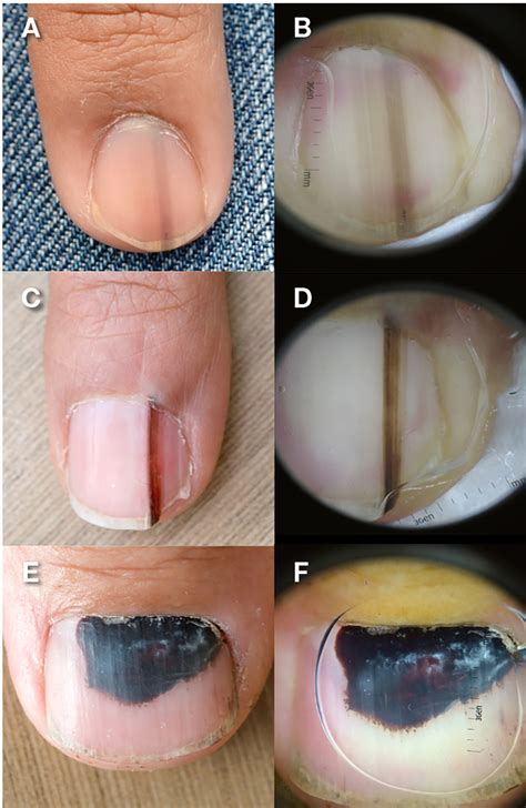 Racgp Pigmented Lesions Of The Nail Bed Clinical Assessment And Biopsy