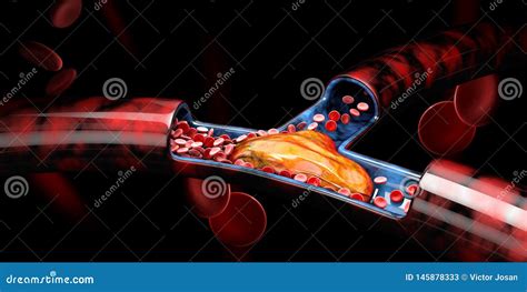 3d Illustration Of Deep Vein Thrombosis Or Blood Clots Embolism Stock