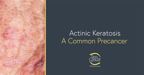 Actinic Keratosis The Skin Cancer Foundation