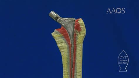 Aaos Ovt Cement In Cement Revision Arthroplasty Technique